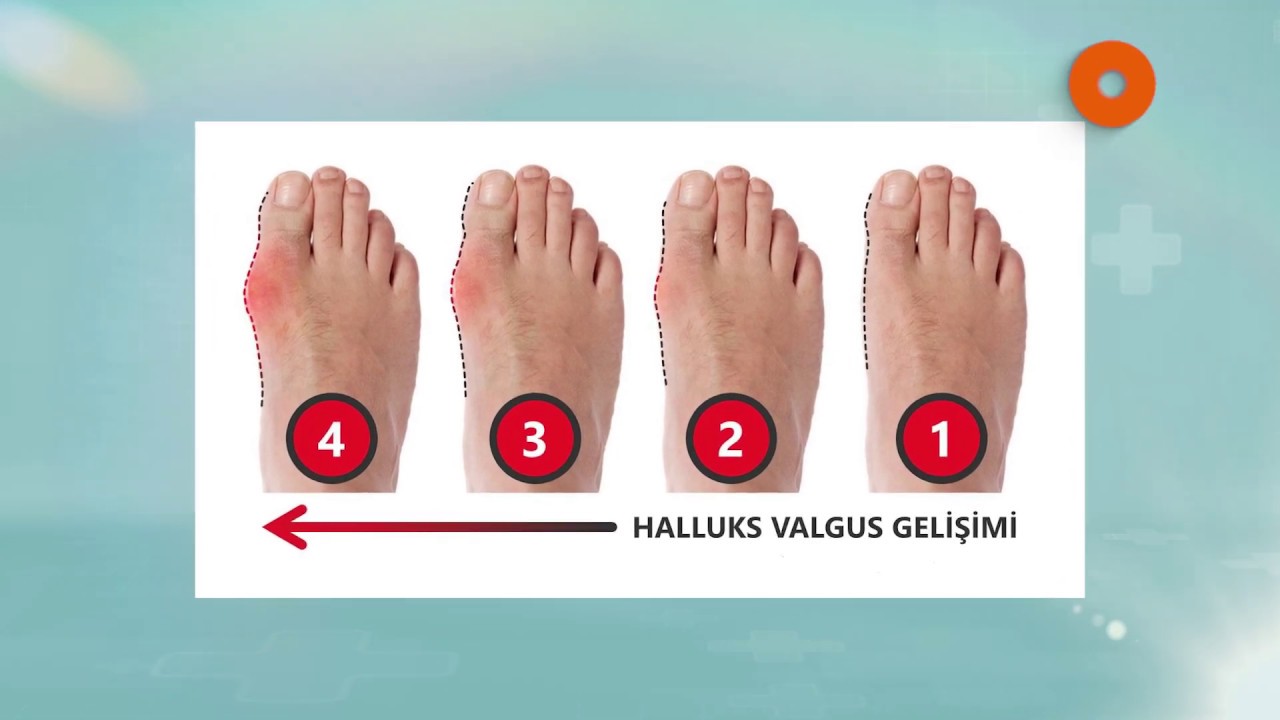 HALLUKS VALGUS TEDAVİSİ VE AYAK SAĞLIĞINA ETKİLERİ