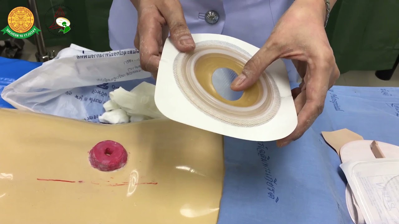 การดูแลทวารเทียมในแง่มุมของการพยาบาล โดย Thammasat ostomy care team
