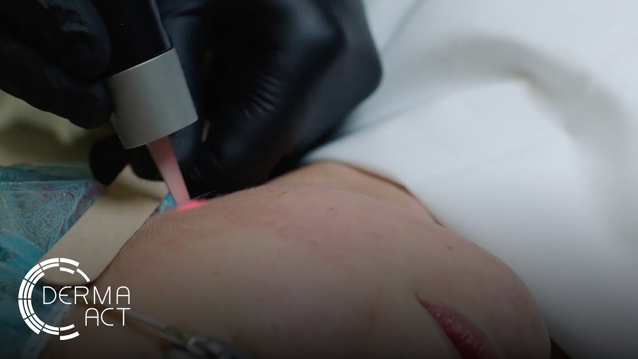 Подмладяване с пикосекунден лазер Picosure