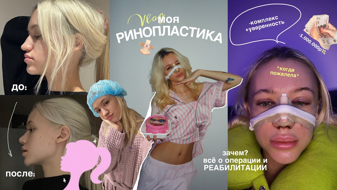 МОЯ РИНОПЛАСТИКА | всё о операции | результат и РЕАБИЛИТАЦИЯ 