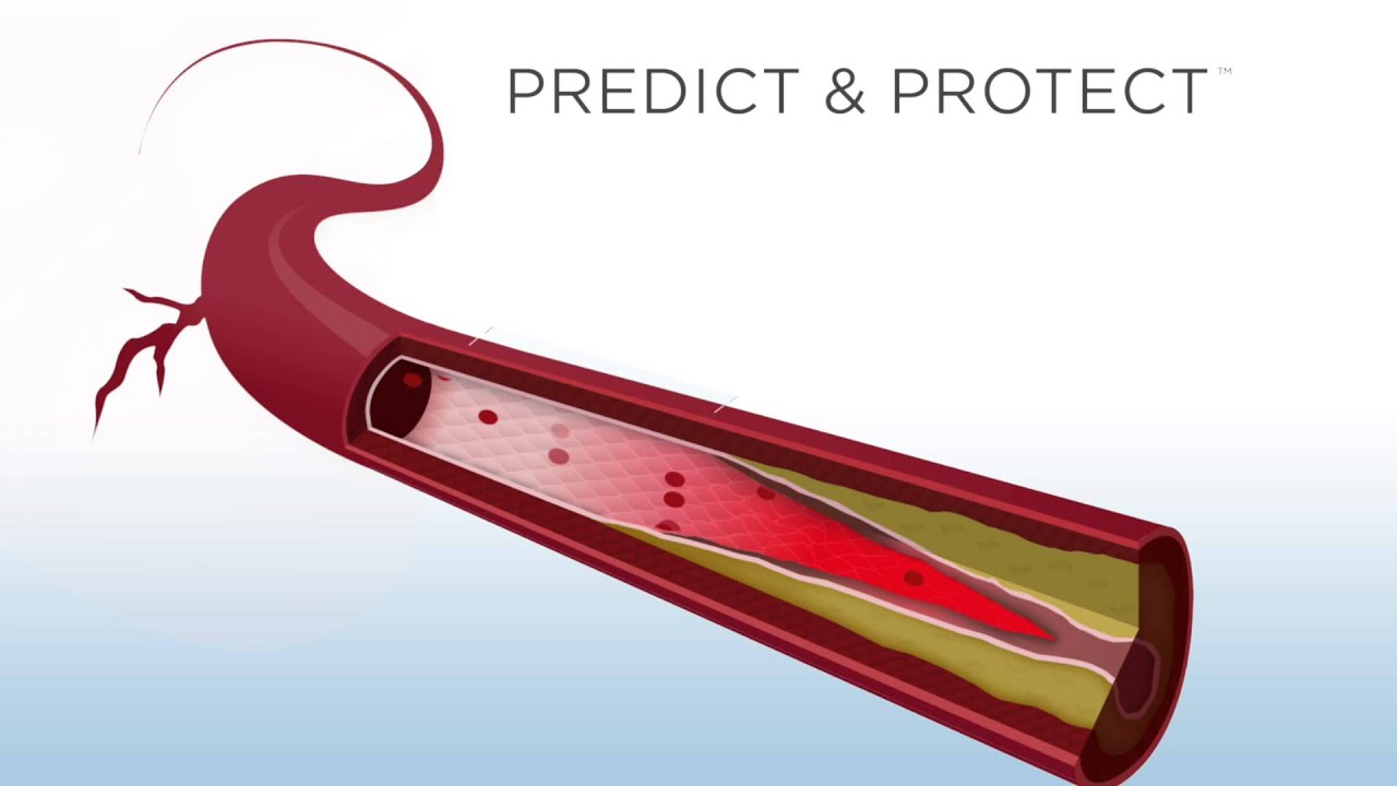 Everist AngioDefender for Patients