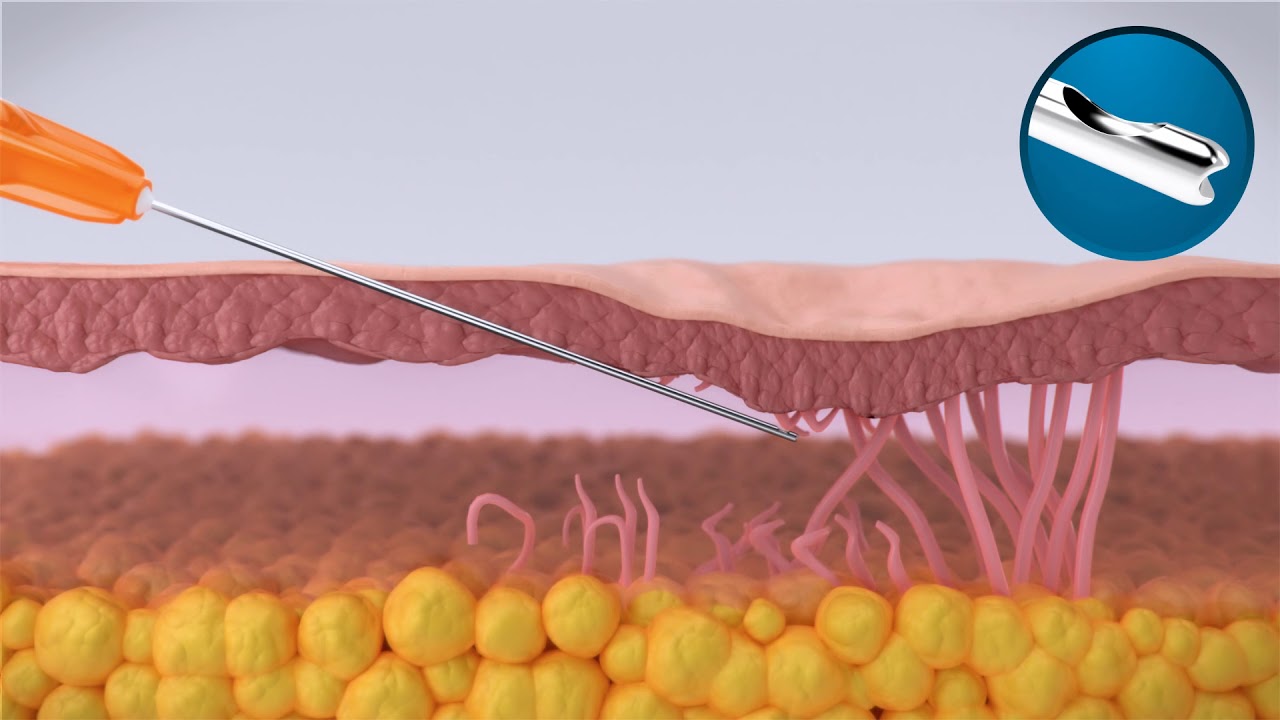 GTI Cannula Animation - How the GTI Cannula Works
