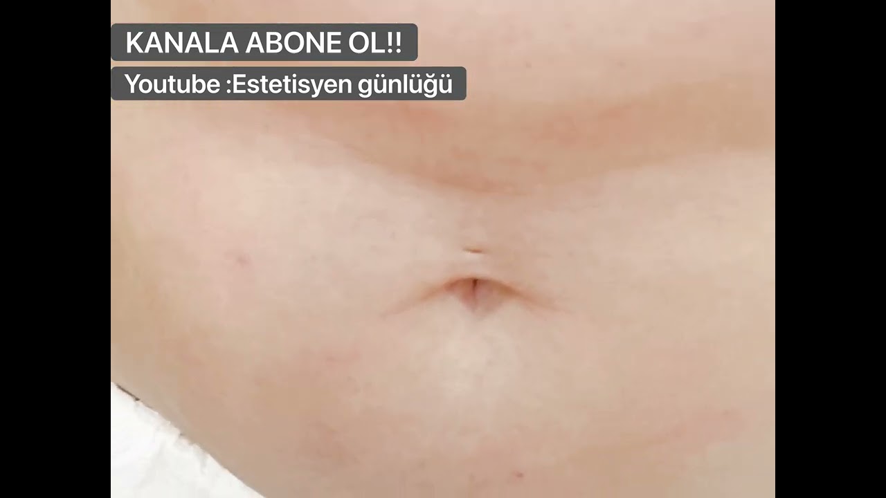 LYPOLYTIC BÖLGESEL İNCELME