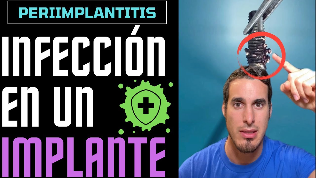 Si llevas IMPLANTES DENTALES esto te interesar&aacute; - INFECCI&Oacute;N DE IMPLANTE o PERIIMPLANTITIS