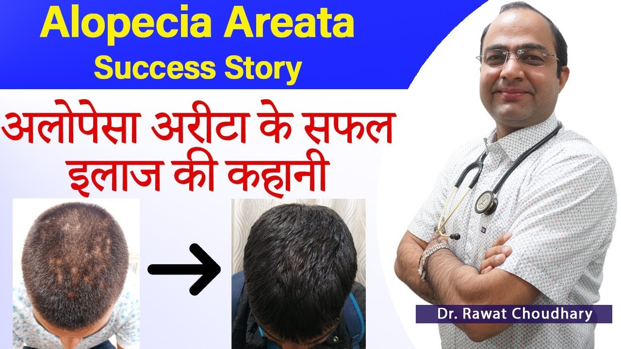 Alopecia Areata Treatment | अलोपेसा अरीटा का इलाज | गंजापन का इलाज | Best Homeopathic Doctor