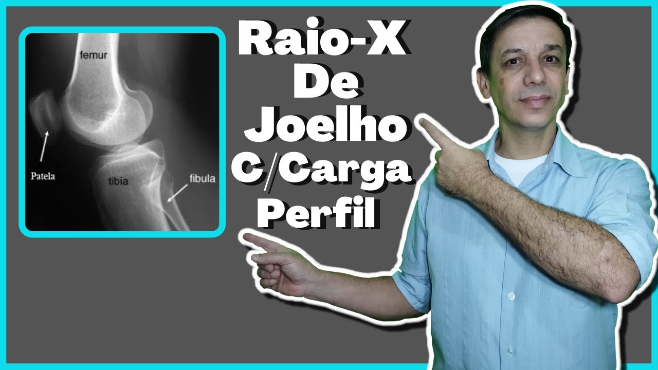 Como realizar e visualizar um raio-x de Joelho com Carga em Perfil.