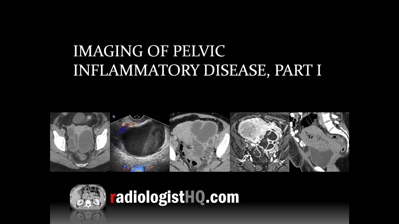 Imaging of Pelvic Inflammatory Disease, Part I