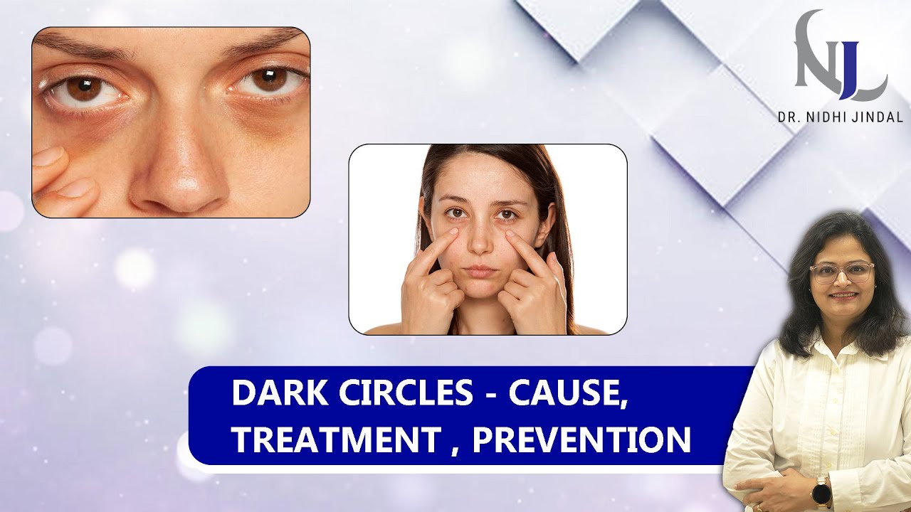 Dark Circles: Causes, Treatments & Preventions | Dr. Nidhi Jindal - Dermatologist
