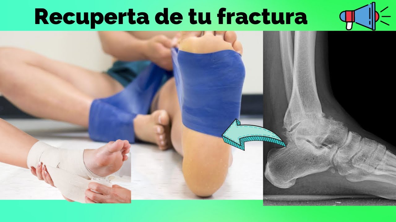 Cómo recuperarse de una FRACTURA DE TOBILLO