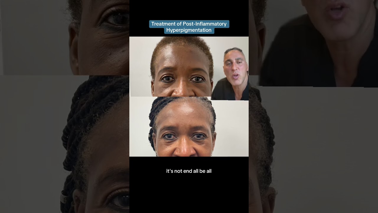 Treatment of Post-Inflammatory Hyperpigmentation
