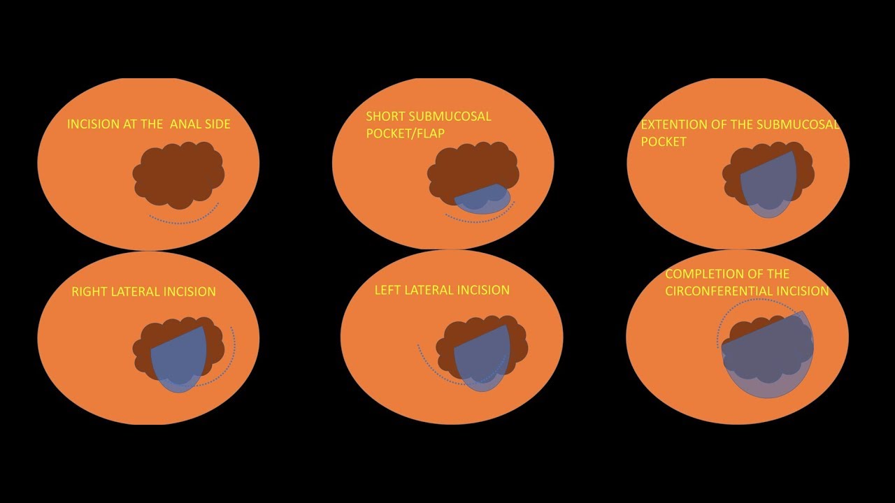 Strategy for Rectal ESD