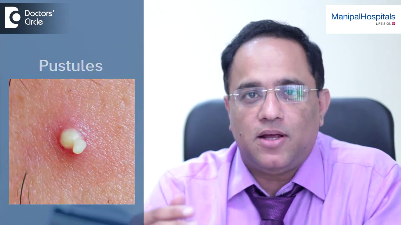 When To Visit A Dermatologist For Acne? | Best Dermatologist In Bangalore | Manipal Hospitals.