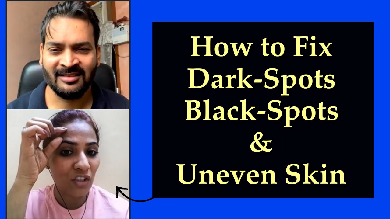 How to fix Dark-Spots, Black-Spots and UnEven Skin?