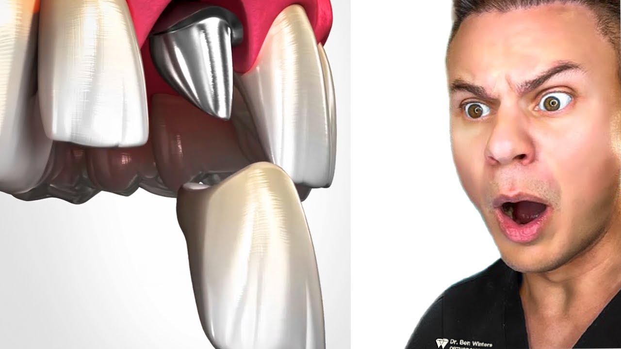 Why Your Bone DISAPPEARS If You Lose Adult Teeth!