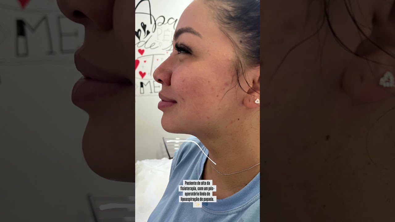 LIPO DE PAPADA RECUPERAÇÃO -CRISALYS PÓS OPERATÓRIO, CURSO PÓS OPERATÓRIO E ESTÉTICA