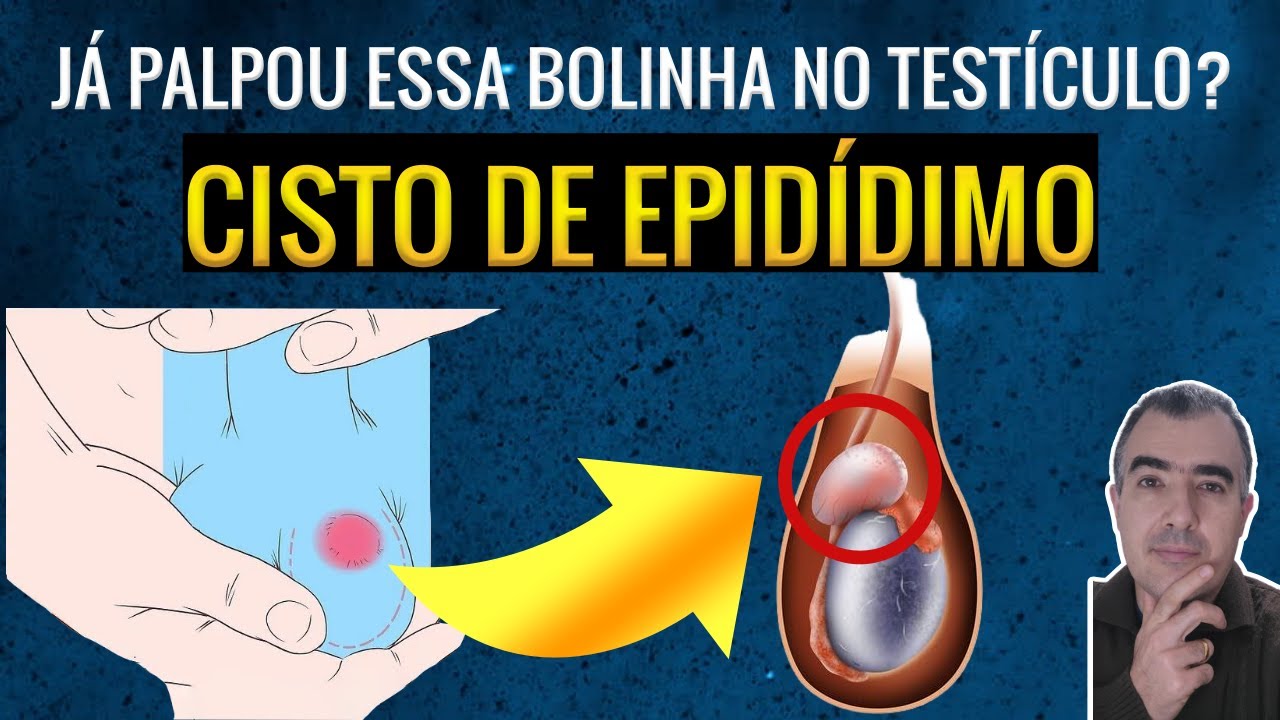 Nódulo no testículo? Pode ser cisto de epidídimo