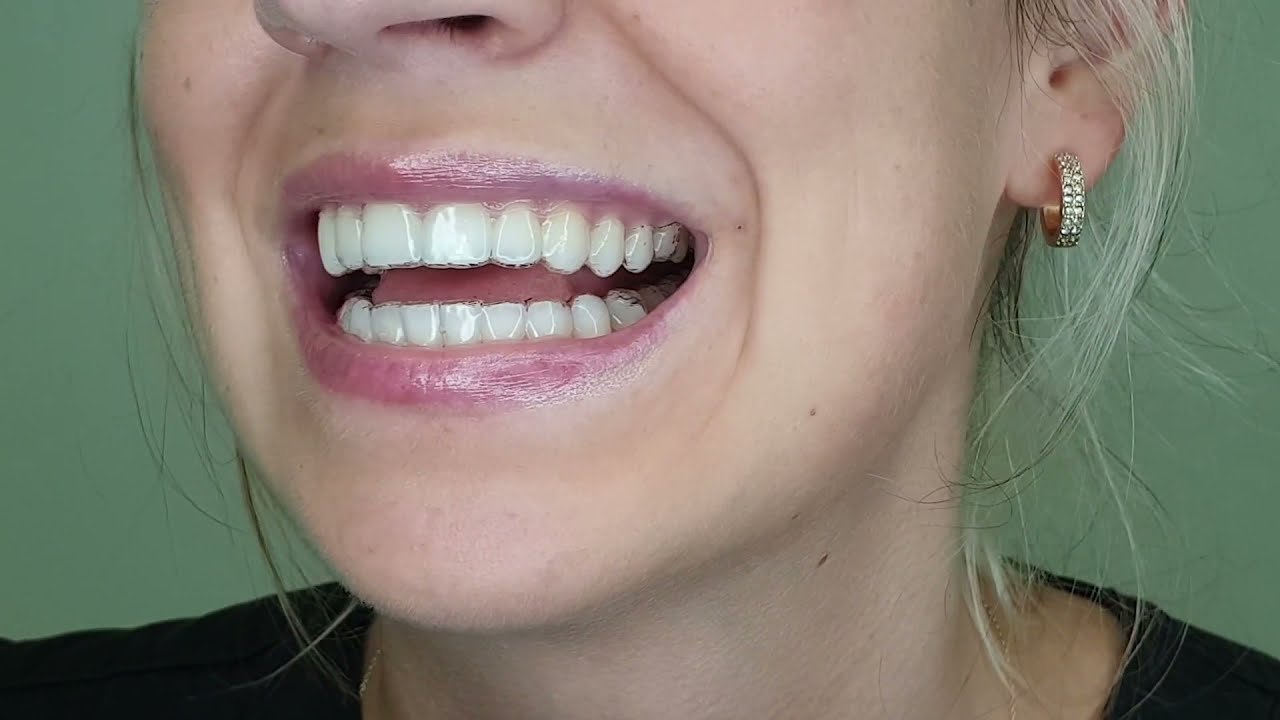 How to monitor your Invisalign - Gentle Dental Care Group
