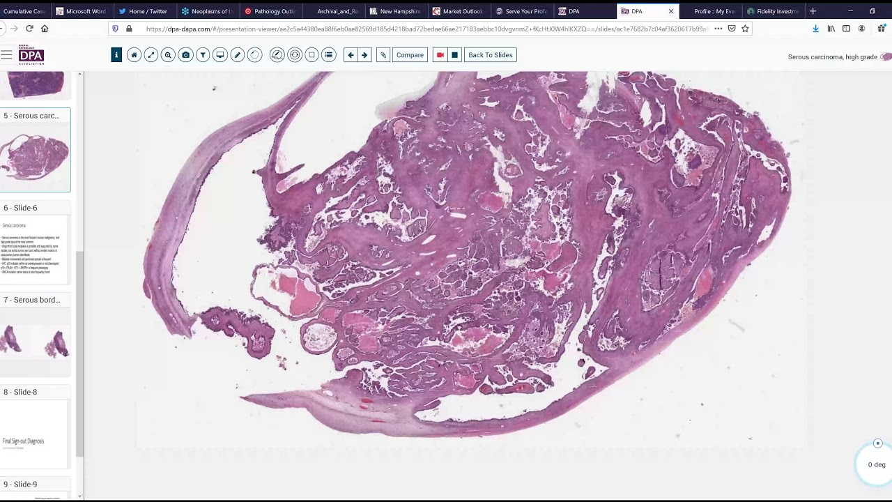 Digital Surgical pathology - Serous Ovarian carcinoma case