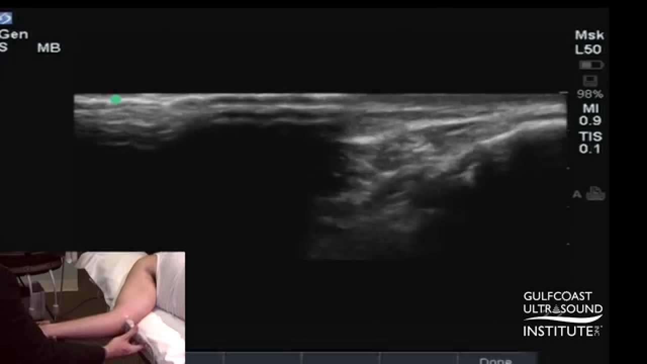 Hot Tip - Ultrasound Demonstration of Ulnar Nerve Dislocation & Snapping Triceps Syndrome