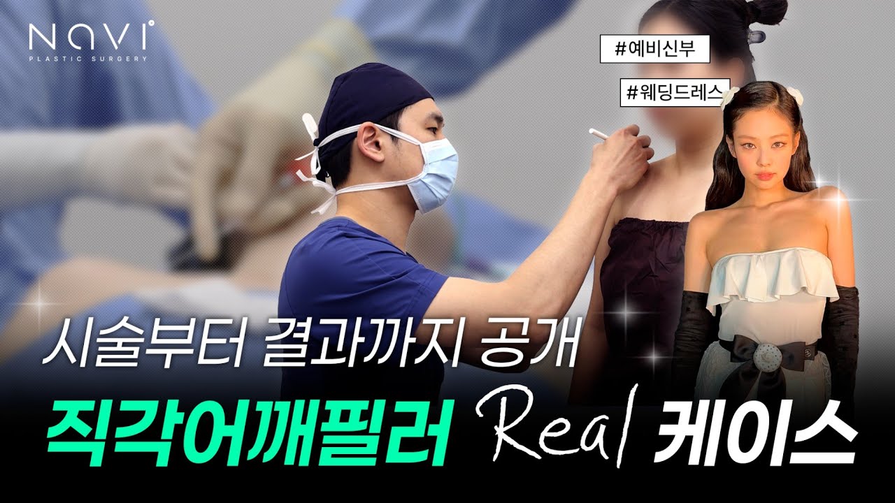 직각 어깨를 만드는 메가필, 성분·원리 부터 시술 후 변화까지 총정리!