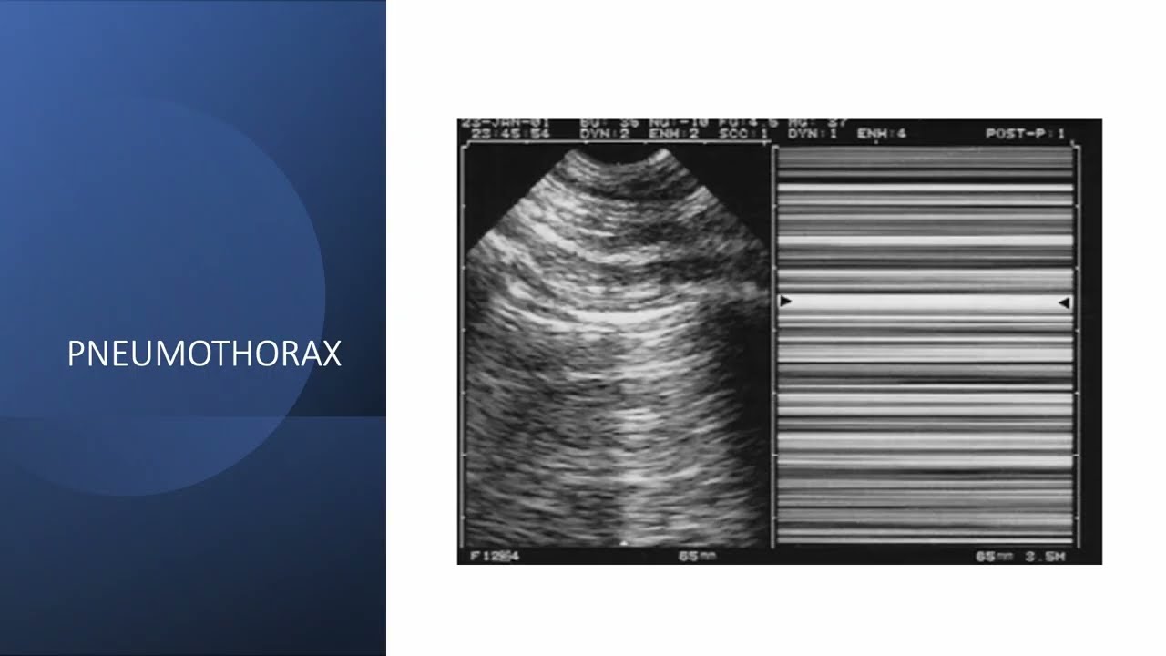 ECMU - Echographie pleurale