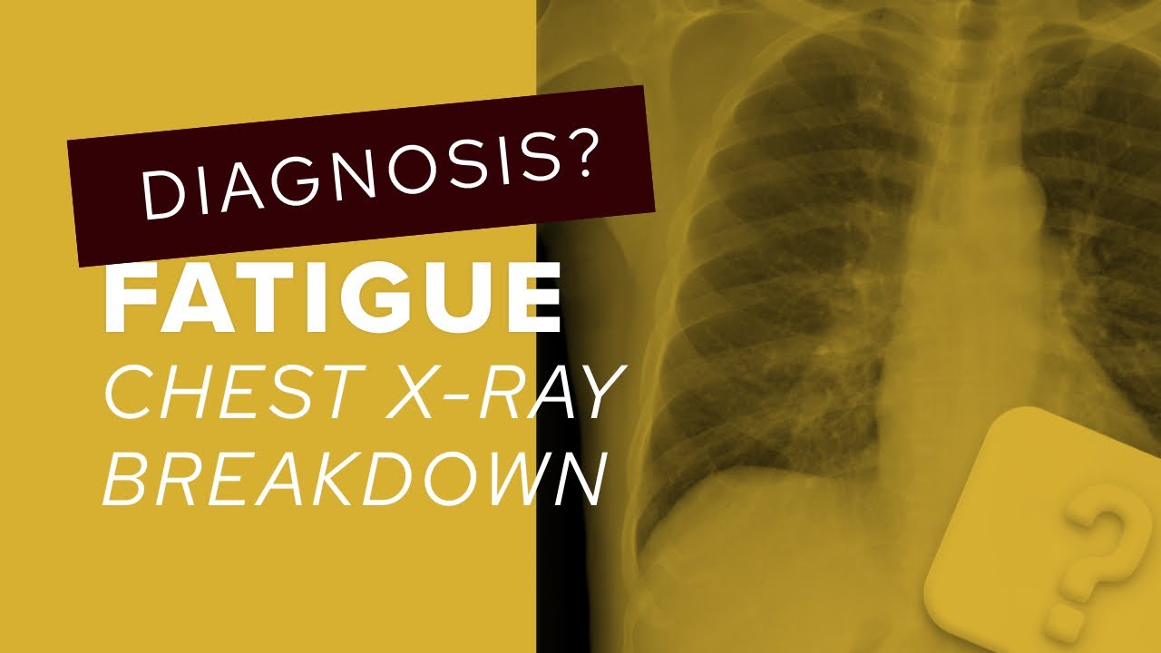 Chest X-Ray breakdown: looking for subtle abnormalities