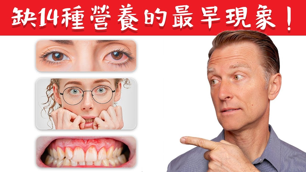 缺14種營養素,最早出現的跡象,自然療法,柏格醫生 Dr Berg