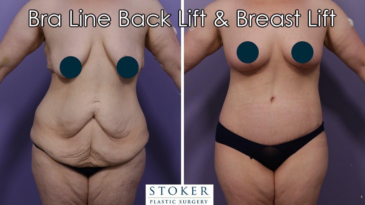 Breast Lift Los Angeles: Top Plastic Surgeon Prepares for a Bra Line Back Lift and Breast Lift