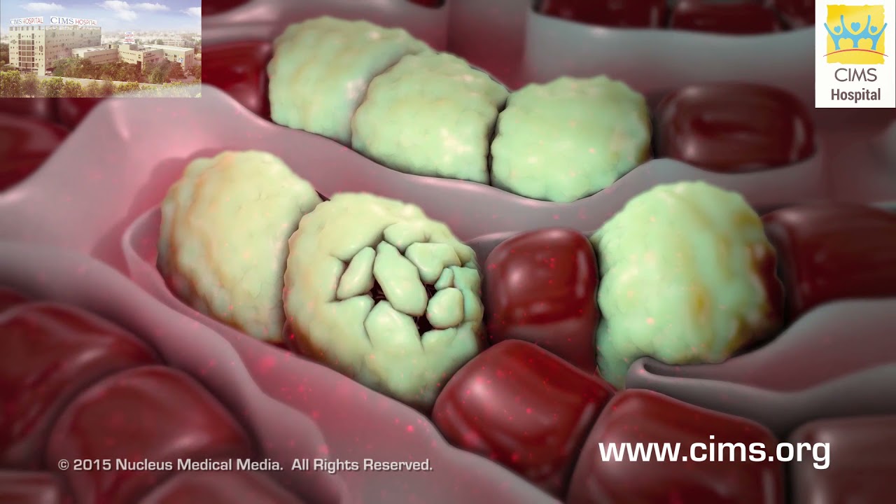 Hepatitis A and B (Hindi)– CIMS Hospital