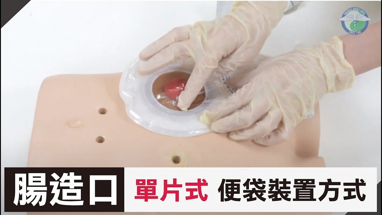 腸造口-單片式便袋裝置方式