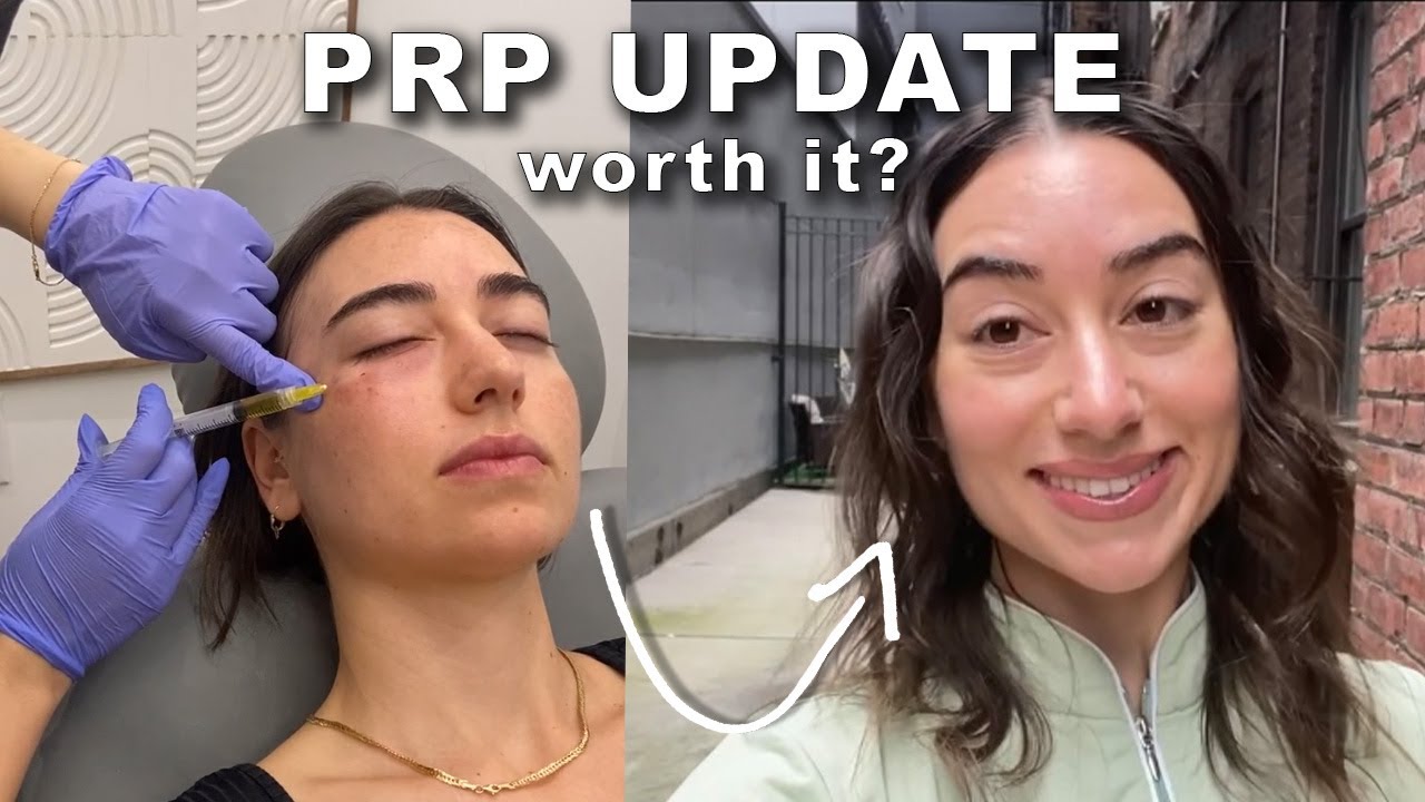 Обновление PRP-терапии под глазами за 6 месяцев