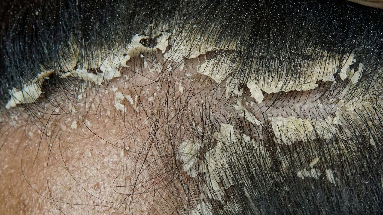 Dandruff scratching removal on head using black combing #DKMO2997