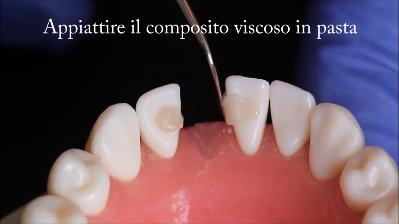 Tecnica per ponte in una sola seduta - Italian Audio