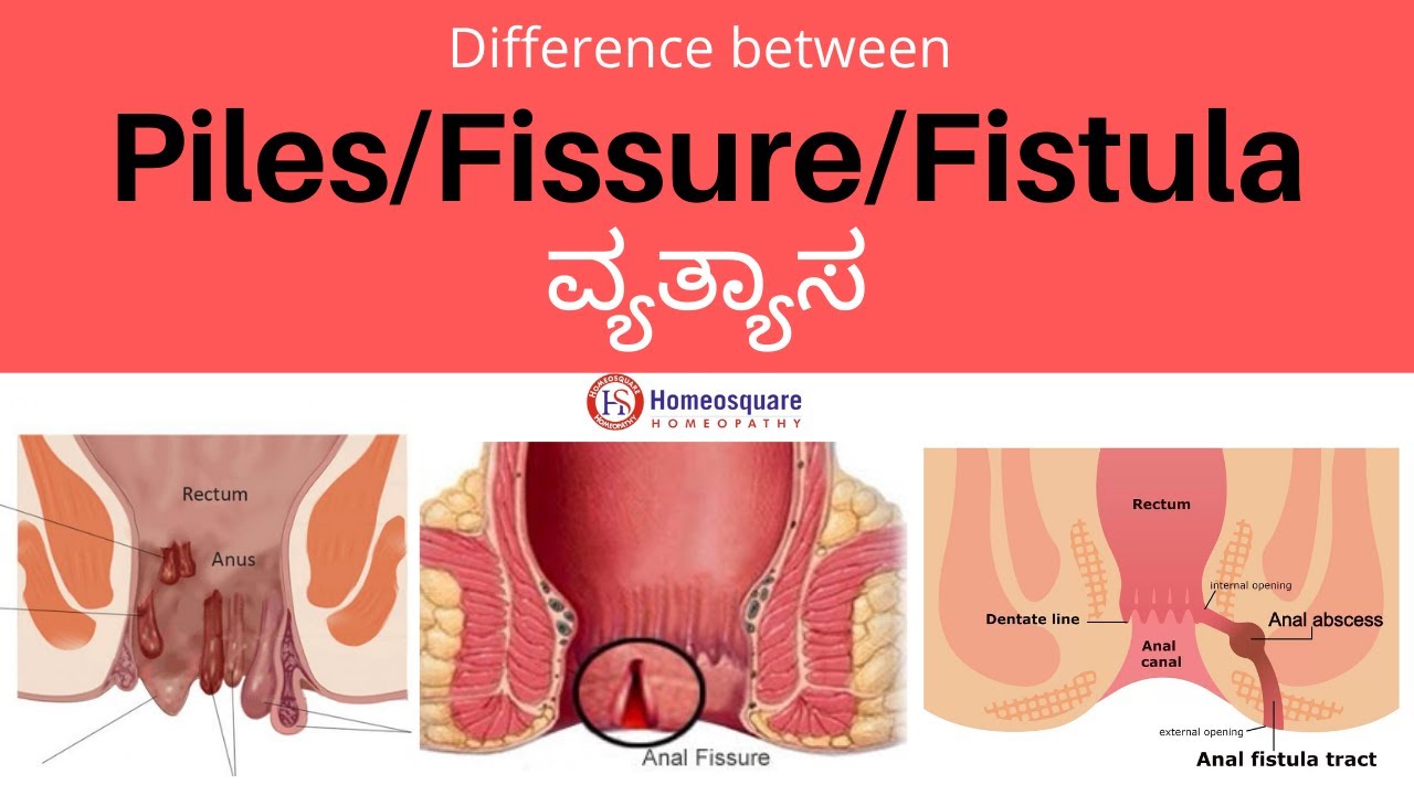 Difference between Piles, Fissure and Fistula in Kannada