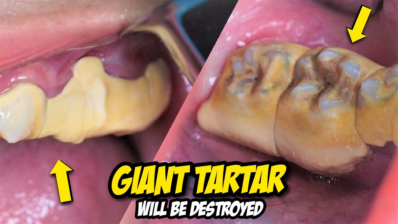26 yo. Female's Teeth | Scaling | Tartar | Karang Gigi | Dentist | Dokter Gigi Tri Putra
