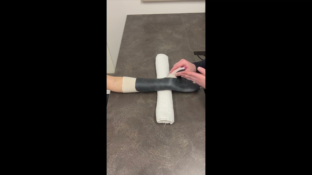 How to Fabricate a Resting Hand Orthosis in the Intrinsic Plus Position