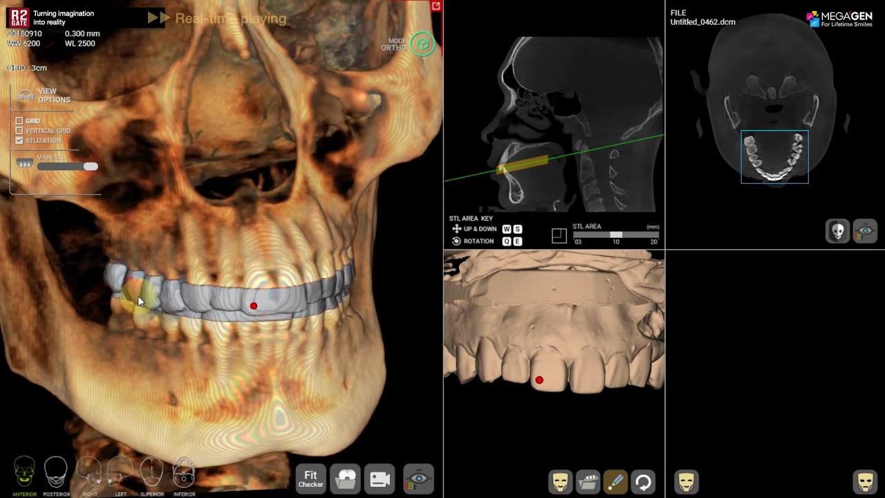 The New 3-Point matching process & result # Natural dentition