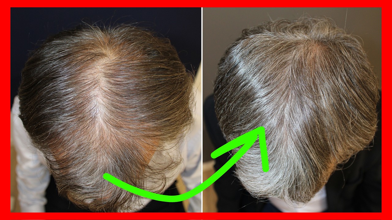 Tienes más de 50 años y quieres recuperar tu pelo sin injerto
