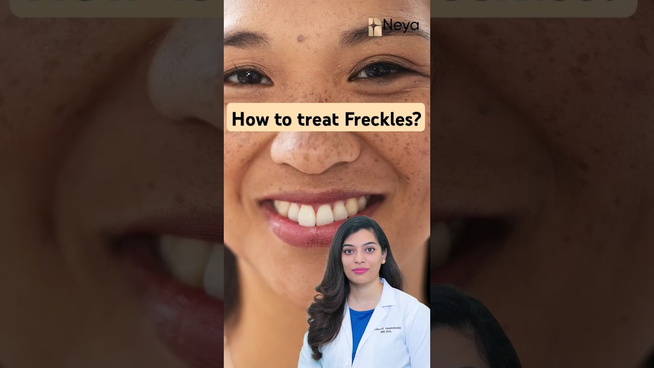 How to treat Freckles on Face | Freckles removal #frecklesface #freckles