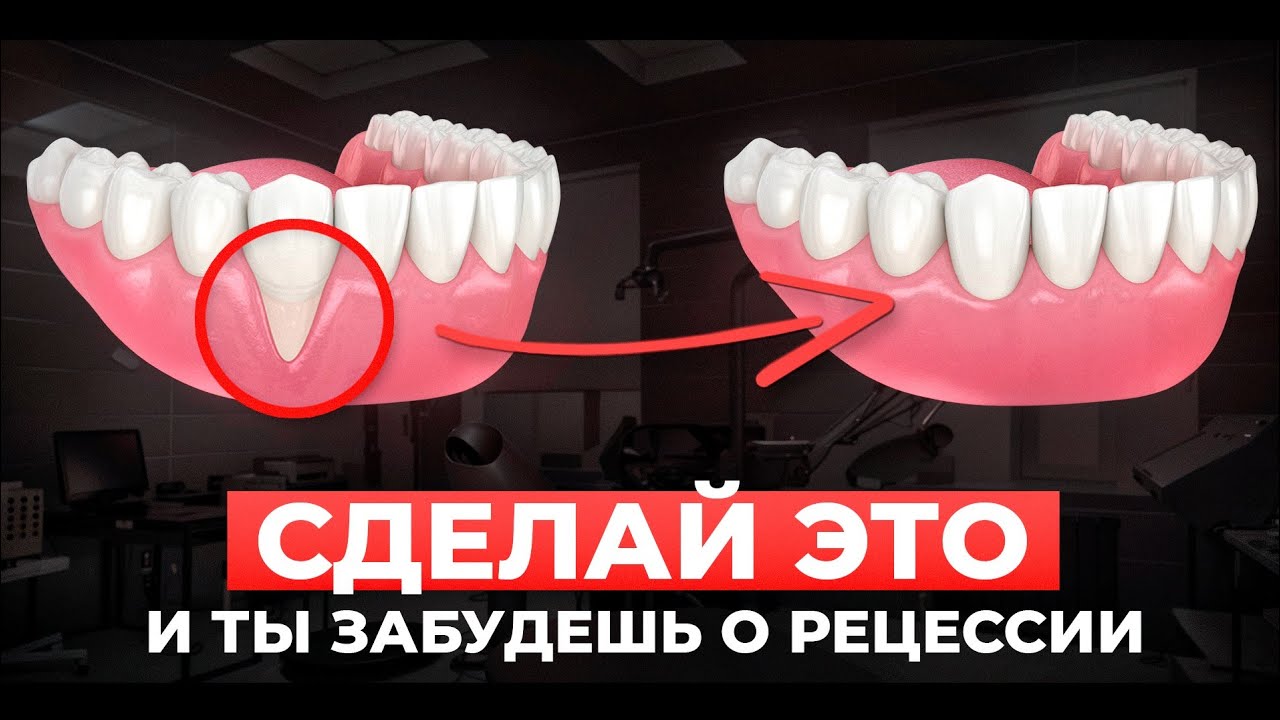 Просто невероятно: Лечение рецессии десны, которое возвращает десны на место!
