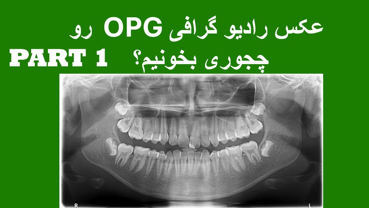 رادیو گرافی پانورامیک (اوپی جی ) رو چجوری بخونیم؟ تحلیل، تفسیر و بررسی کامل. (قسمت اول)   OPG