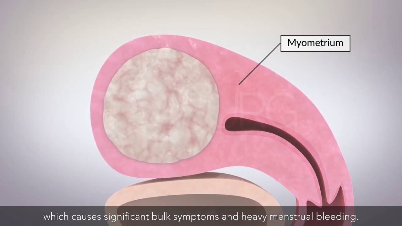 Laparoscopic myomectomy