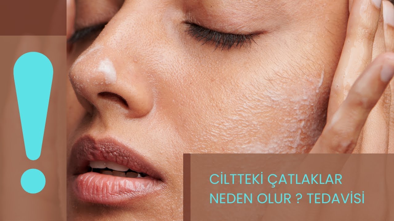 Ciltteki Çatlaklar (deri çatlakları ) Nasıl Geçer ? | Dr. Pınar Akan | Doktorundan Dinle
