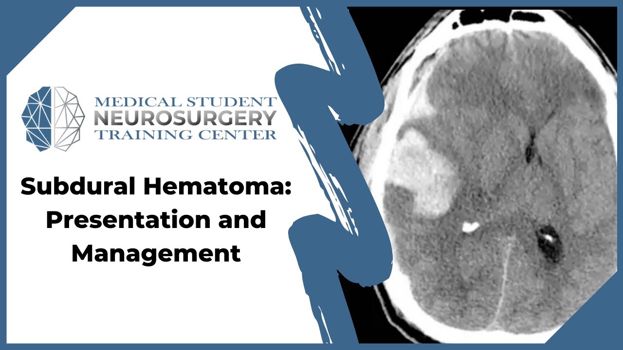 Subdural Hematoma: Presentation and Management