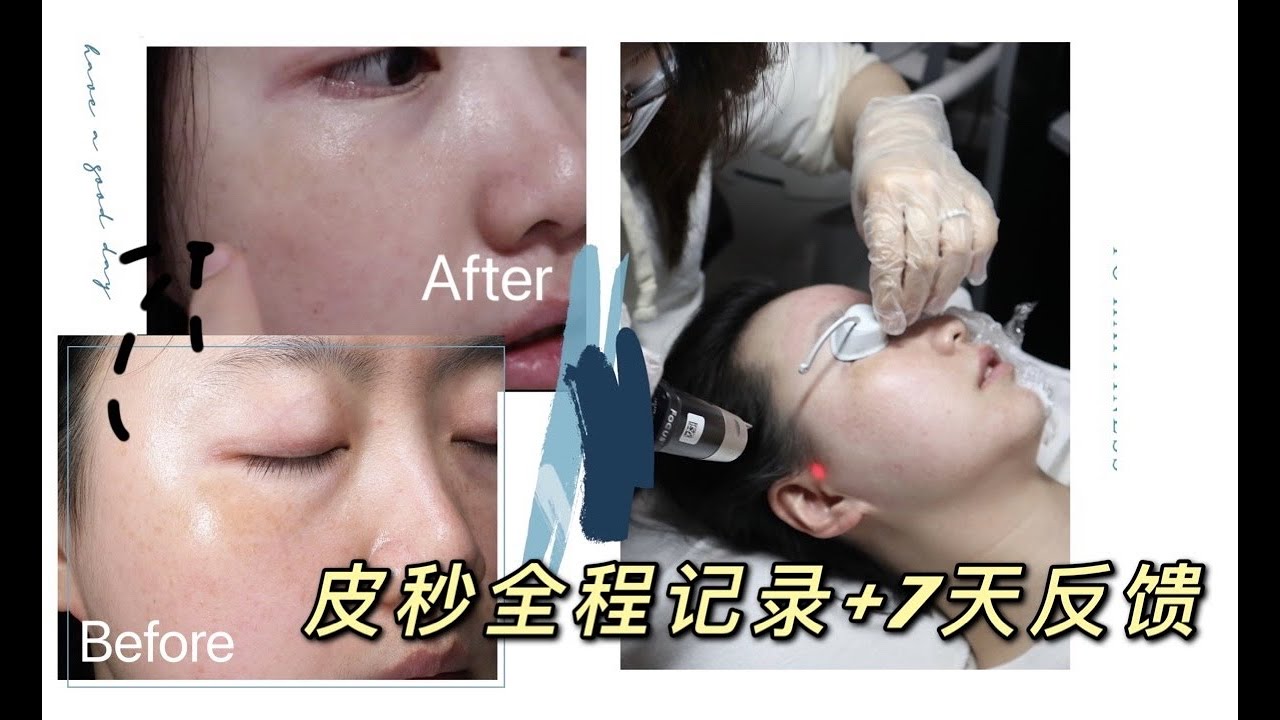 我终于去做皮秒啦！Picosure Laser review｜蜂巢皮秒全过程记录+激光后七天护肤记录｜皮秒祛斑｜皮秒祛雀斑｜皮秒祛晒斑黄褐斑｜激光祛斑