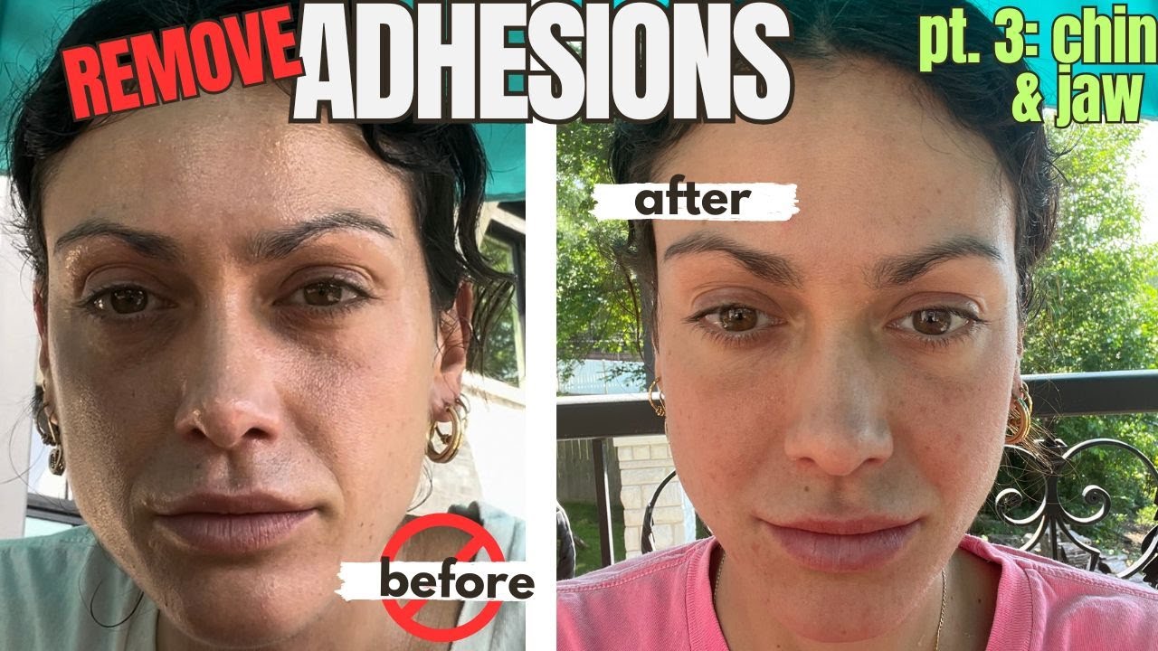 ADHESIONS: The glue your body makes that could be destroying your face | Pt. 3 Chin & Jawline