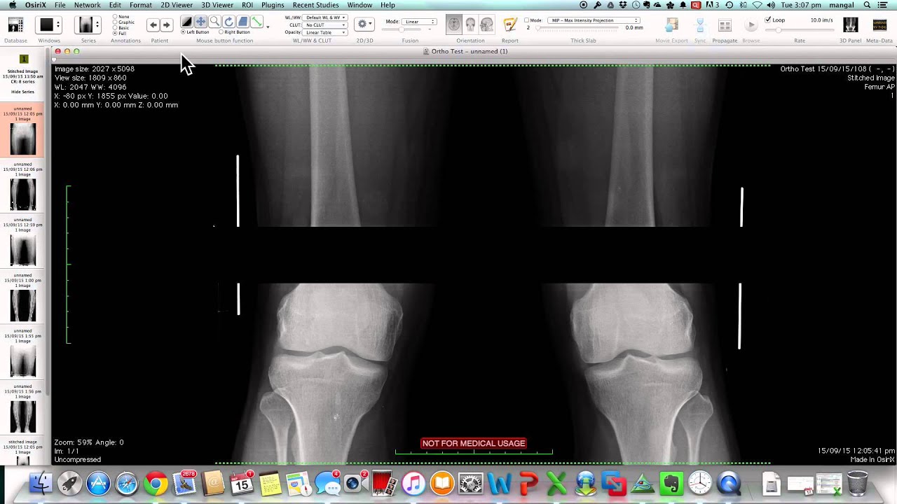 Full length X-rays by 'stitching' in osirix