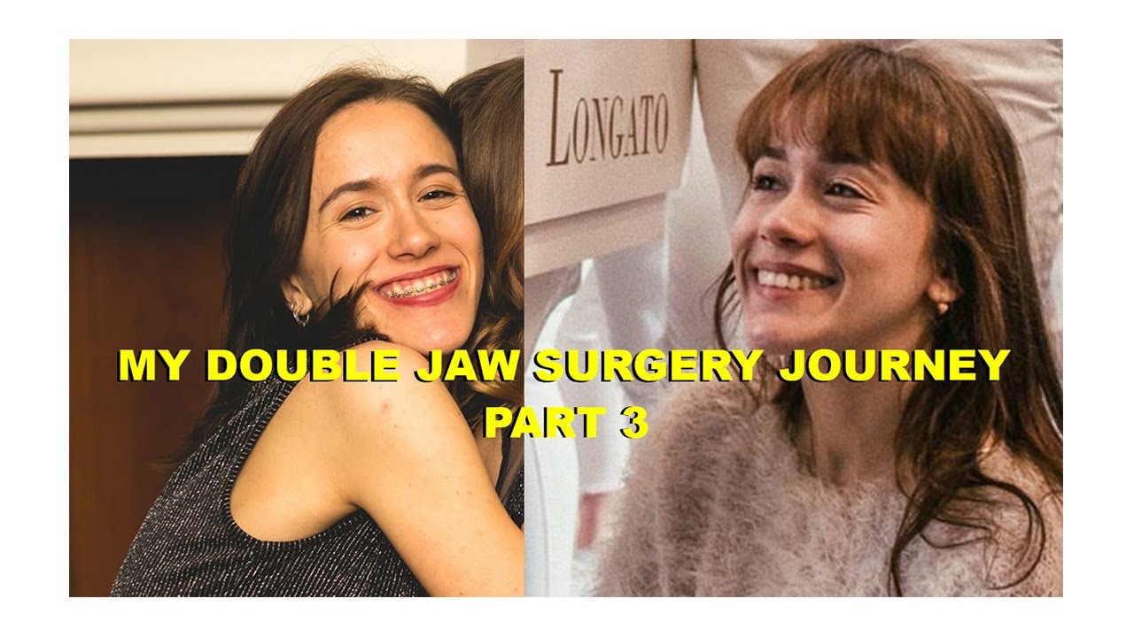 My Double Jaw Surgery Journey Part. 3