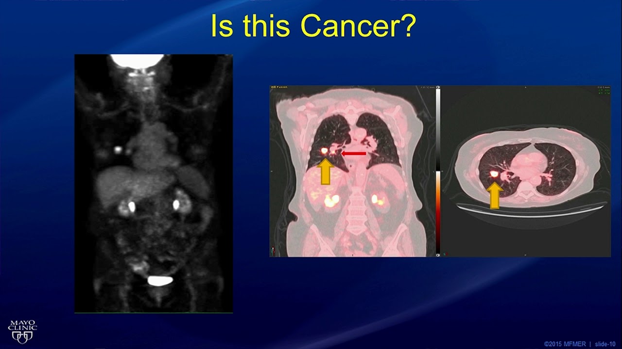 Molecular Imaging for the Detection of Cancer