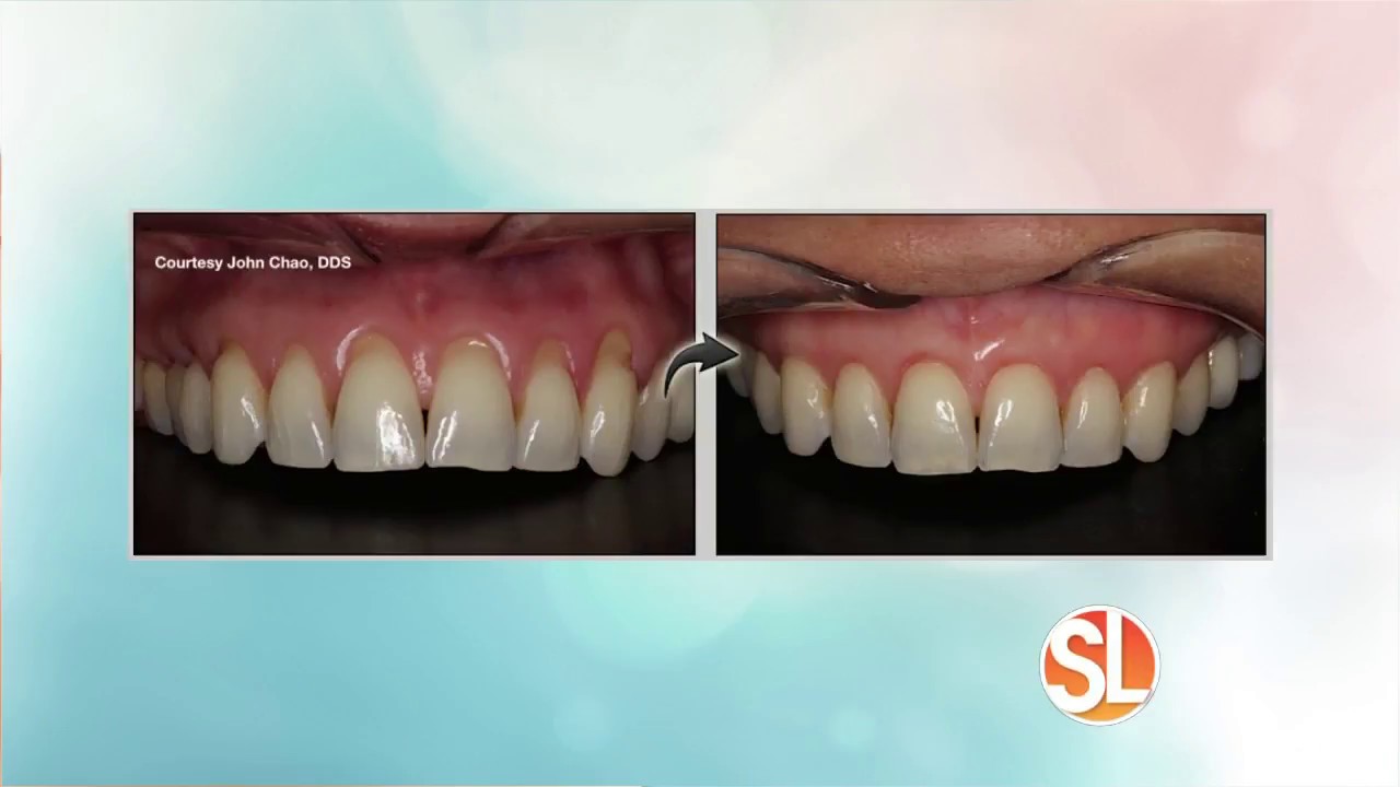 Dr. Erik Svans Describes Pinhole Gum Rejuvenation On Sonoran Living
